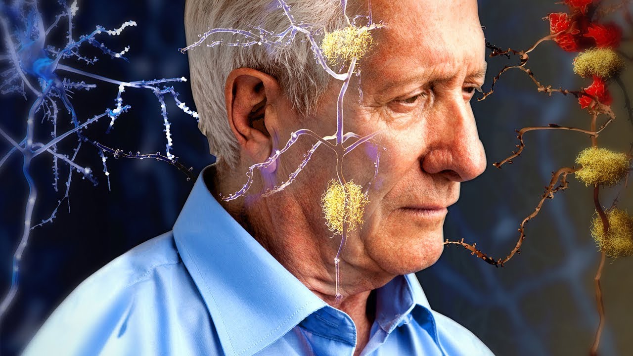 What Are The Stages Of Alzheimer’s Disease?