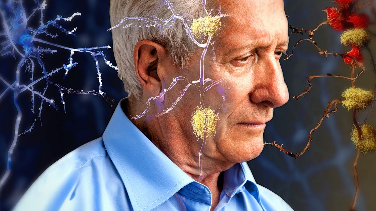 What Are The Stages Of Alzheimer’s Disease?