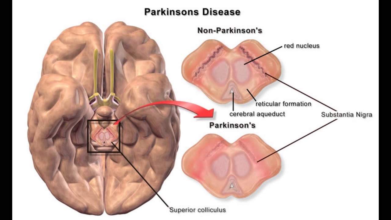 Who Gets Parkinson’s Disease